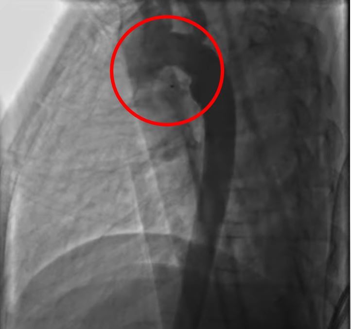 (花蓮慈院提供)開放性動脈導管術後