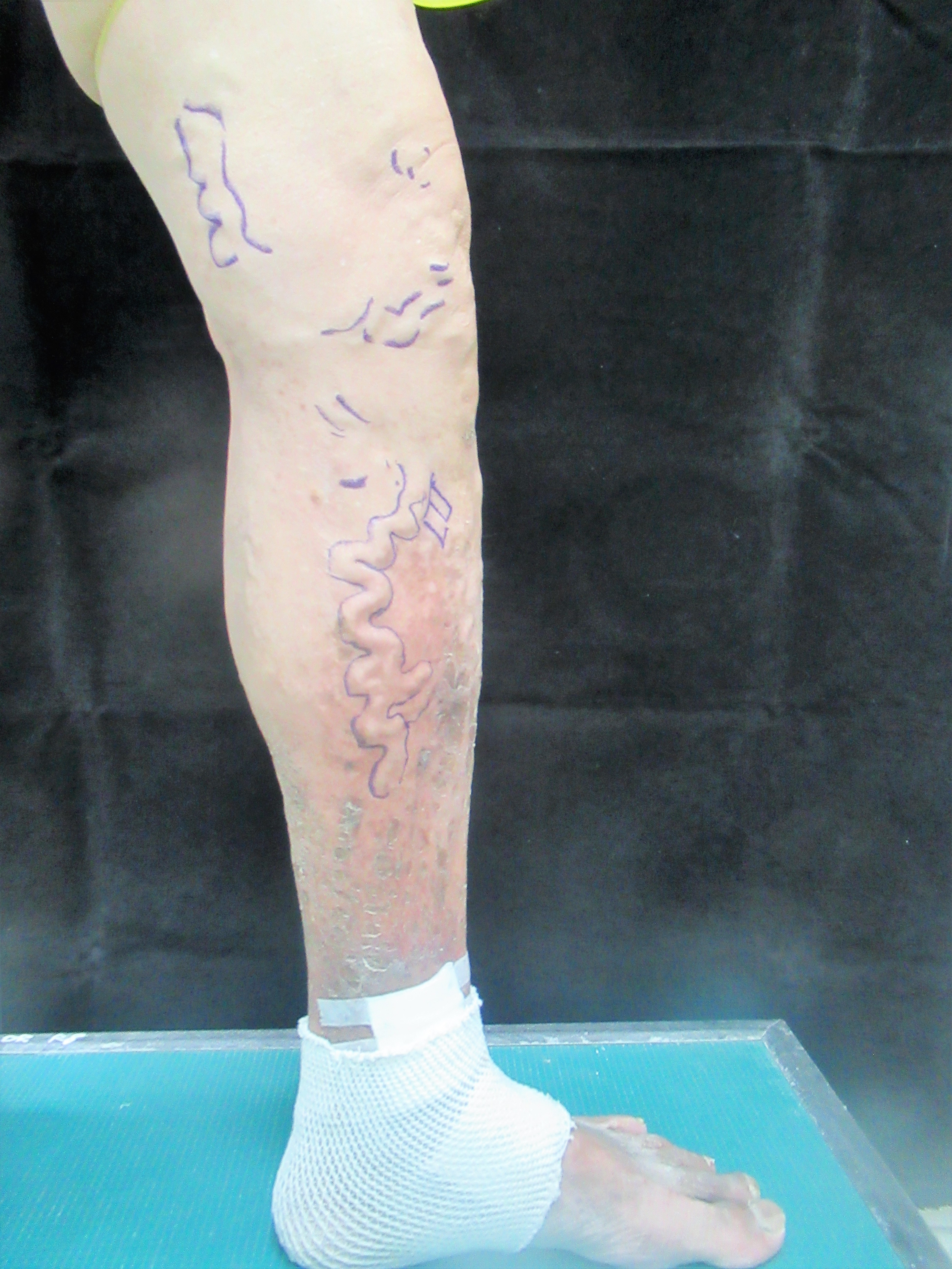 張姓男子的靜脈曲張嚴重彷彿蚯蚓爬滿小腿(圖片來源：彰化醫院提供)