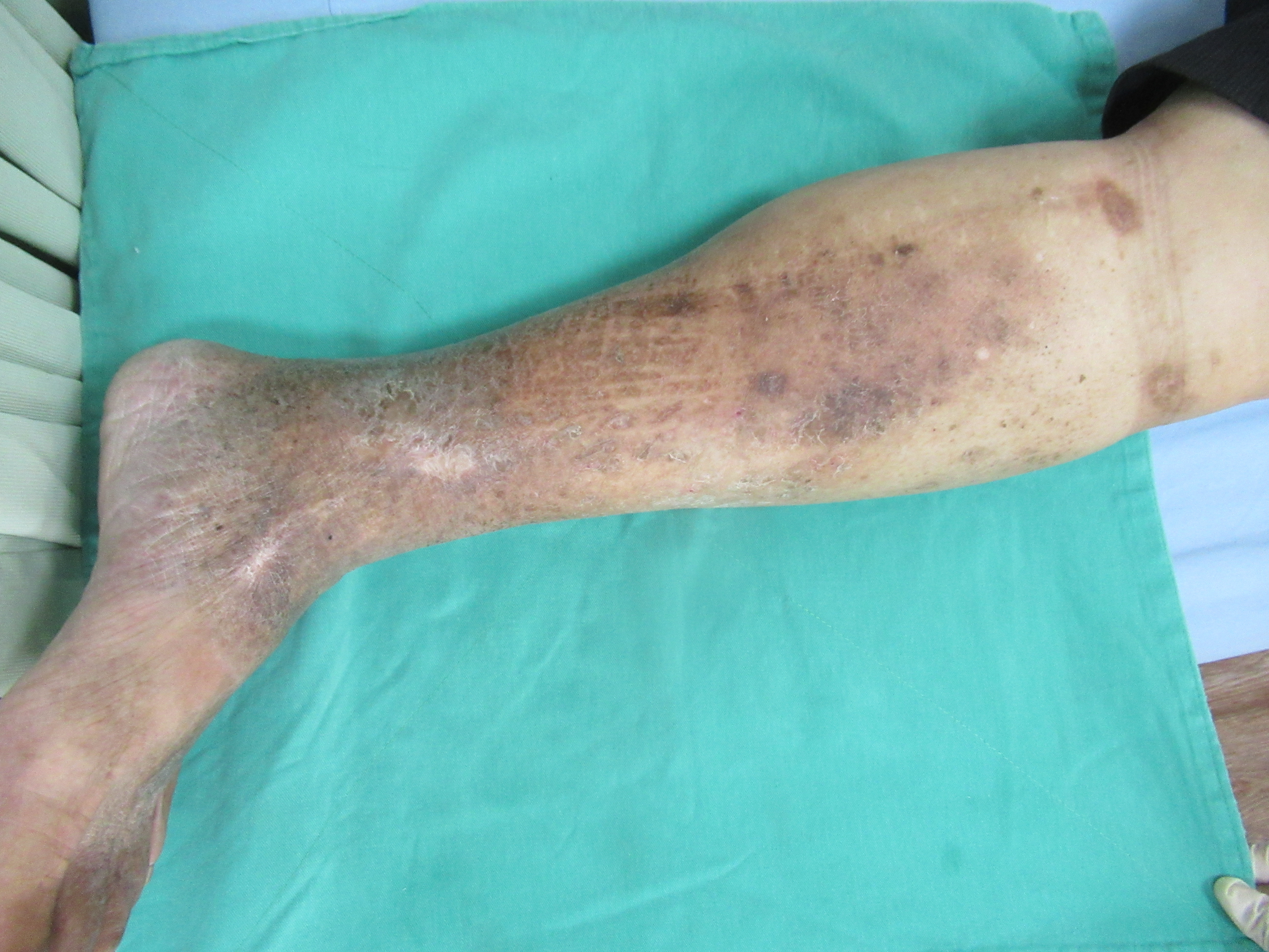 經過微創手術之後張姓男子的靜脈曲張獲得明顯改善(圖片來源：彰化醫院提供)