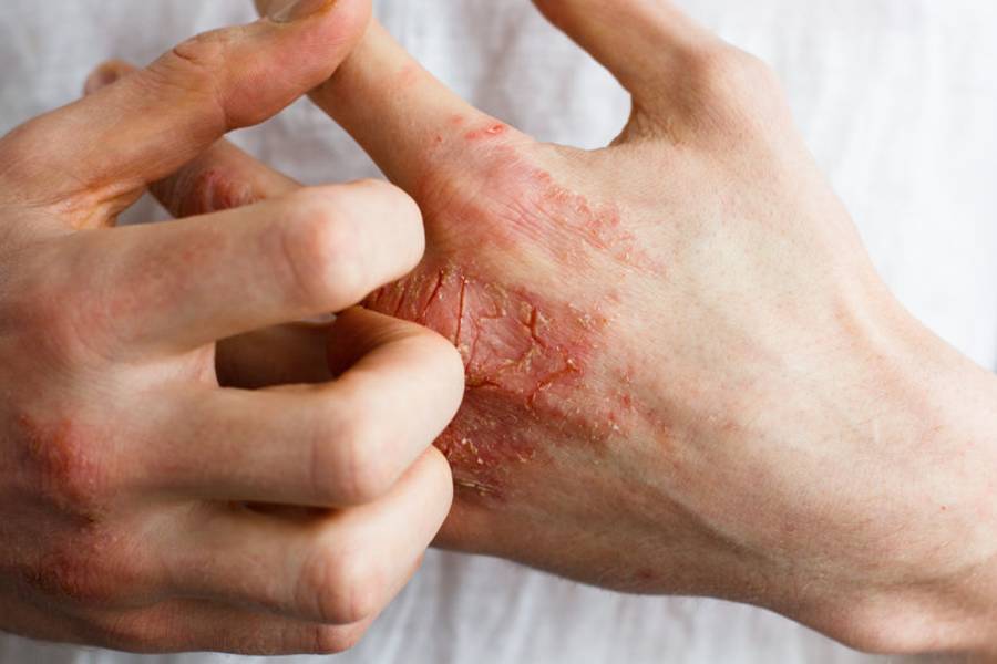 異位性皮膚炎與食物過敏